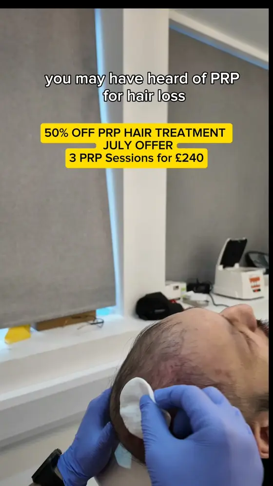 50% Off PRP Hair Treatment