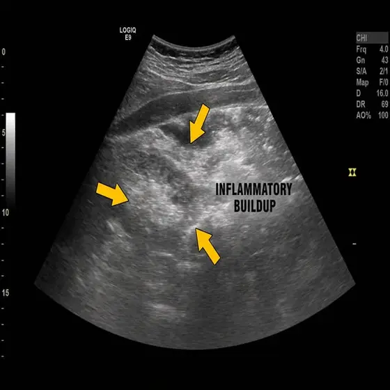 The Truth About Rheumatoid Arthritis Fatigue ☝️