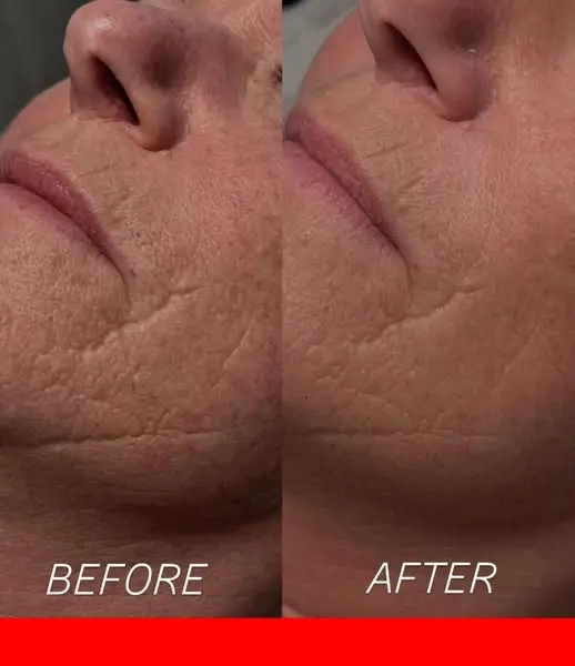 ✨ Microneedling Results ✨

The before & after images shown are not our own pati…