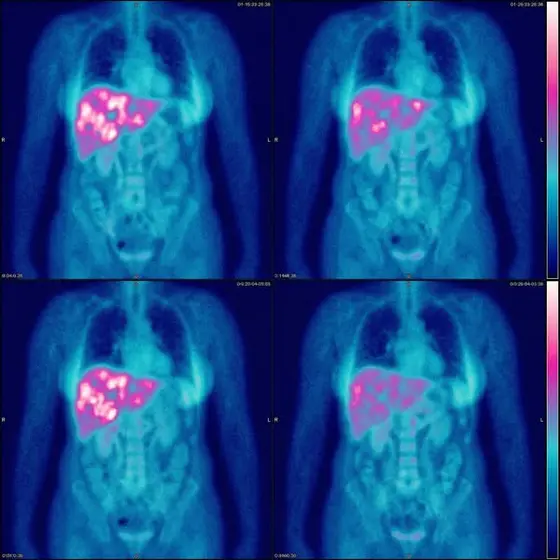 Read if you have fatty liver