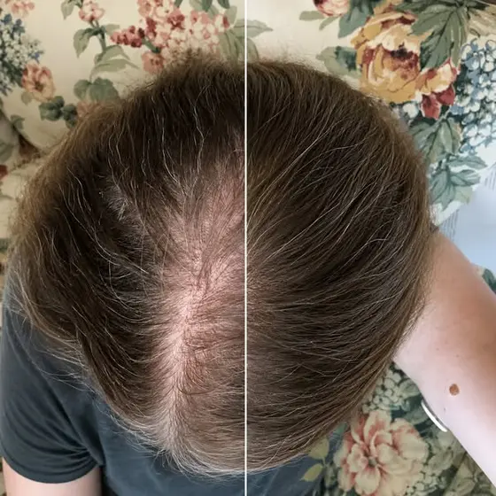 The No BS Solution For Thyroid Hair Loss