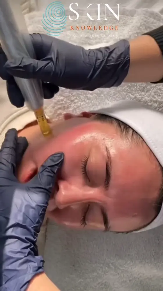 Skin Micro-needling 🧬 Now £179 Harley Street, London