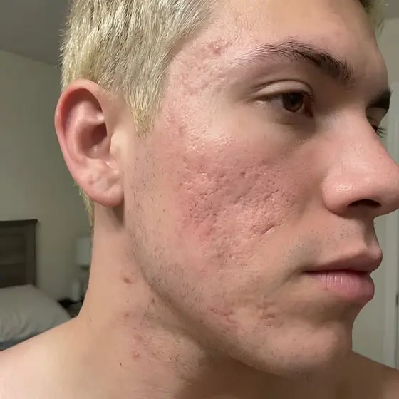 Finally Fade Acne Scars For Good