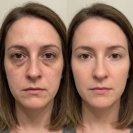 I Study Facial Volume Loss for a Living. Here Are the 7 Things You Were Never T…