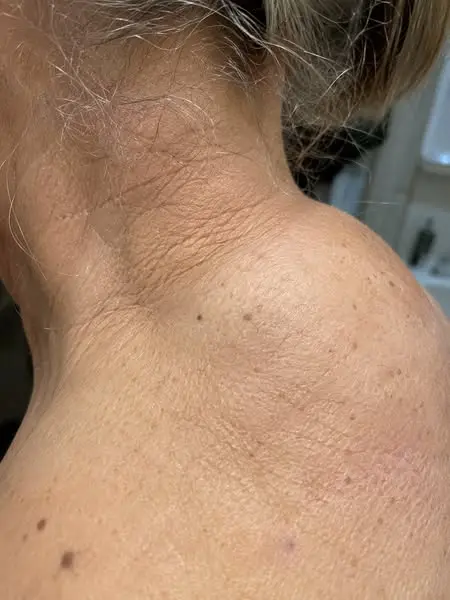 Why The Neck Hump Won't Go