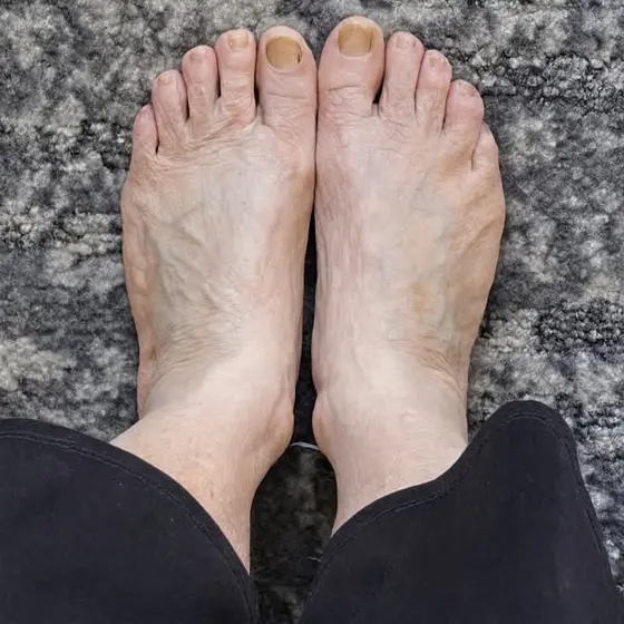 After 12 Years Neuropathy I Finally Found Relief