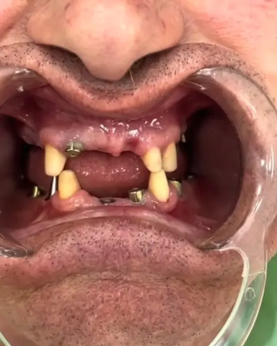 Denti Fissi anche con Poco Osso