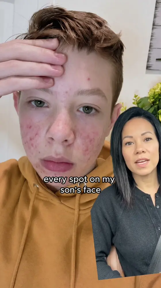 Acne Gone in Days!