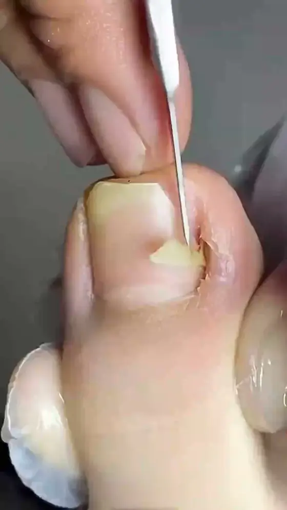✂️ Extra-Scharfer Nagelknipser – Präzision für dicke & eingewachsene Nägel
Müh…