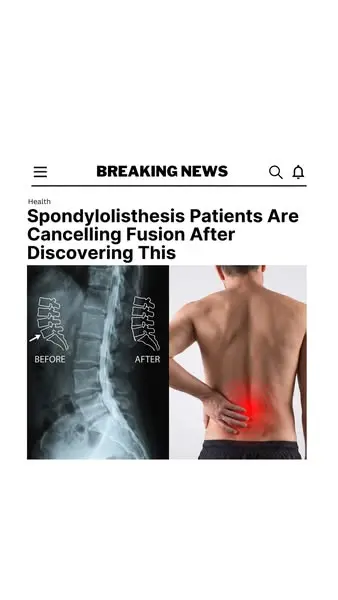 What Spondylolisthesis Patients Are Finding Right Before Fusion