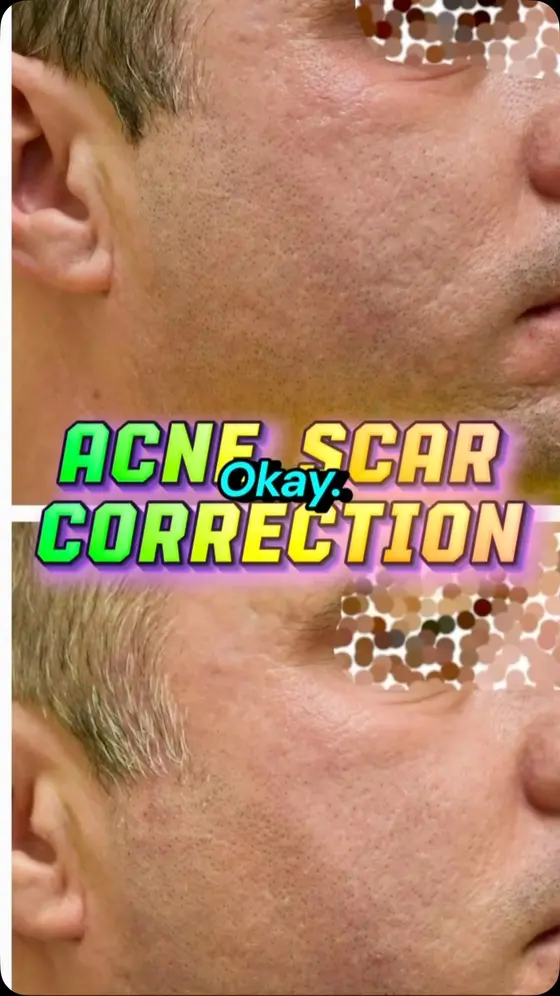 Permanent, safe, and effective acne scarring and skin texture correction combin…