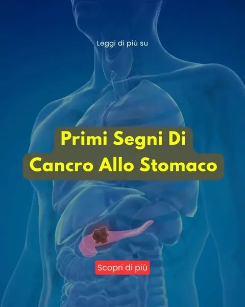 Leggi di più sui primi segni di cancro allo stomaco