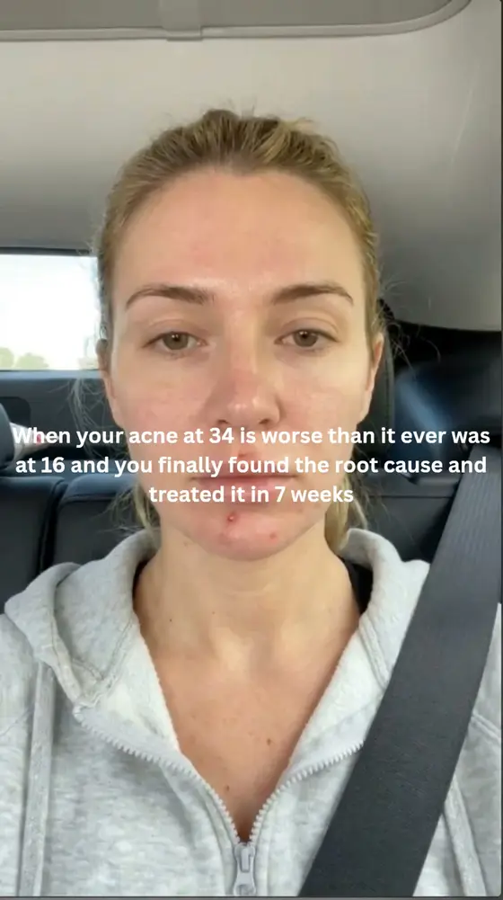 No prescriptions. No harsh chemicals. Just results.