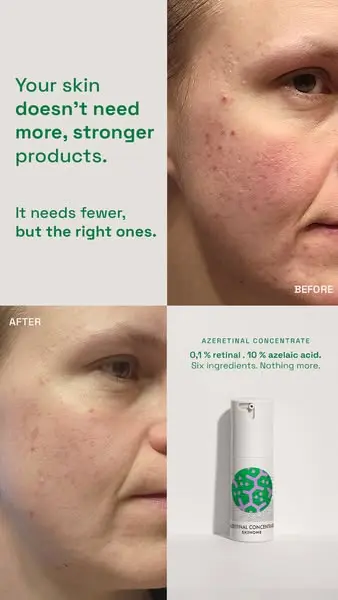 Skincare for acne prone skin