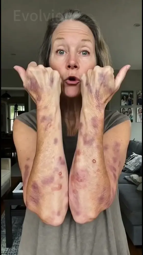 🔥 Moles / warts / acne / psoriasis / varicose veins / eczema / rosacea / age s…