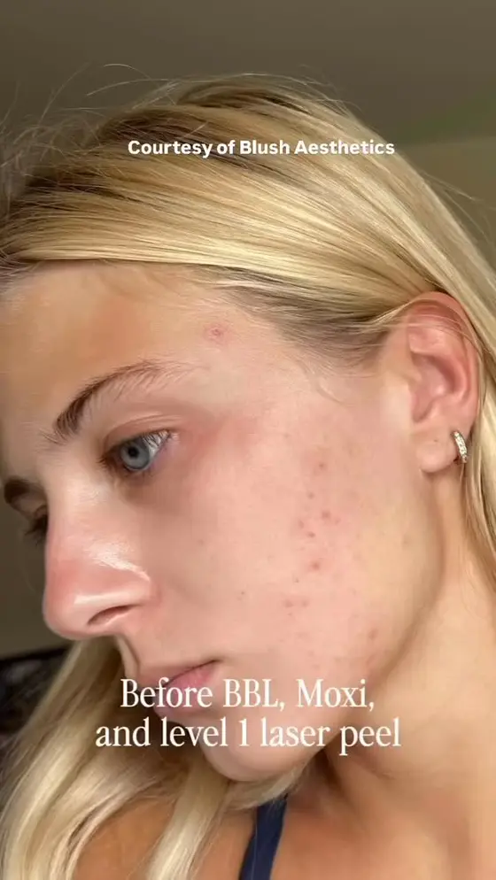 Give new life to your skin with SCITON LASER