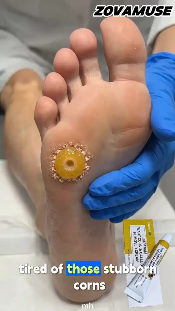 😰 Your Wart Is Getting Worse Every Day You Wait — Stop It Now
