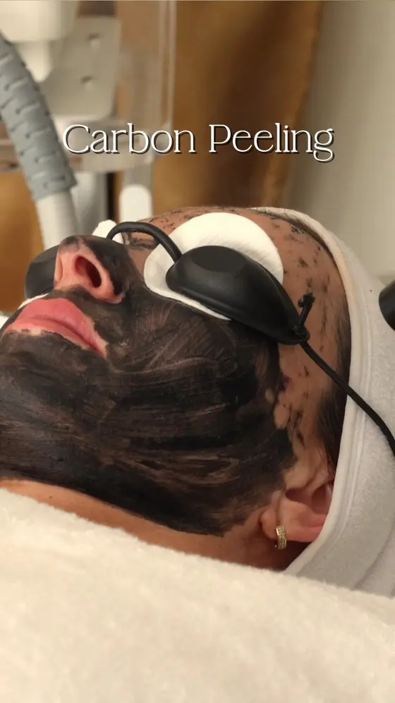 Reveal Your Glow with Carbon Peeling ✨
Carbon peeling is a gentle yet powerful…