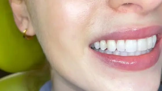 Invisalign, teeth whitening and composite bonding. Simple, pain-free treatment…