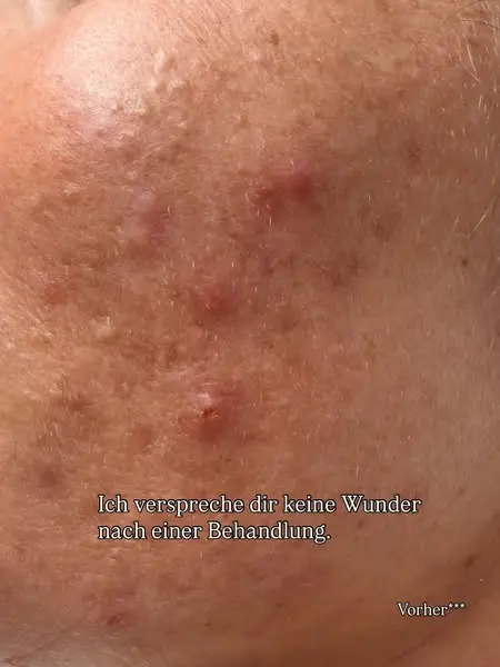 Wichtiger Hinweis zu den gezeigten Bildern: 🤍

Die Behandlung ist noch nicht a…