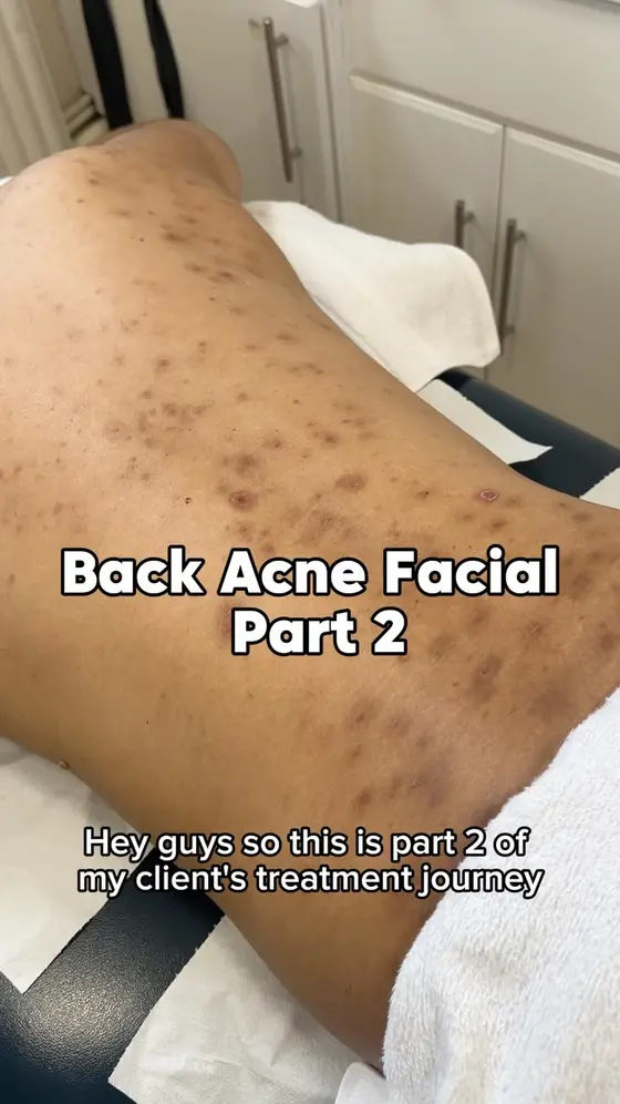 Part 2 of this incredible back acne journey ✨

Consistency is key! 🙌

Today we…