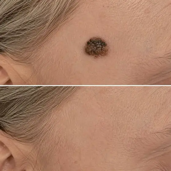 Read This If Your Skin Bumps Keep Coming Back