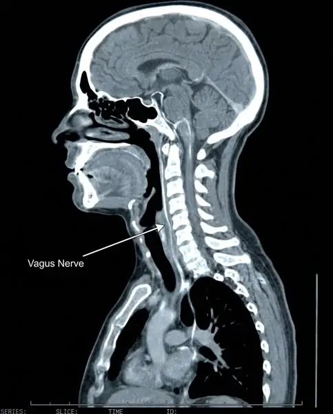 They told me yoga would reset my vagus nerve.