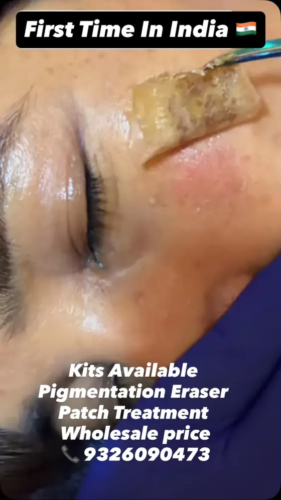 First Time in India 🇮🇳 International Pigmentation Protocol
Treatment
Say good…