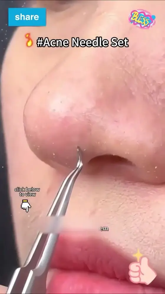 Blackhead Remover Tools