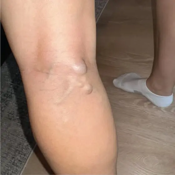 The compression socks made it worse 😢