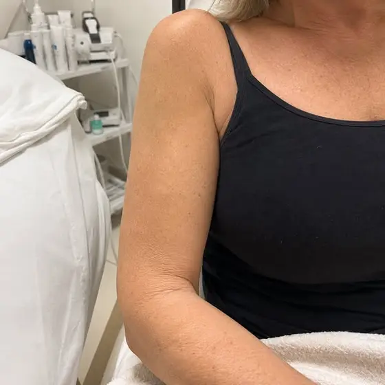 Read this if your arm skin changed texture