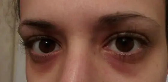 Leute fragten ständig, ob ich krank bin