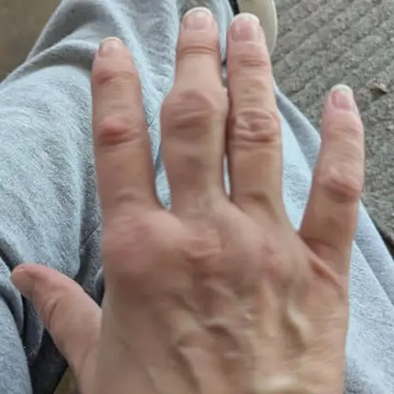 My hands let me down. I needed help with everything.